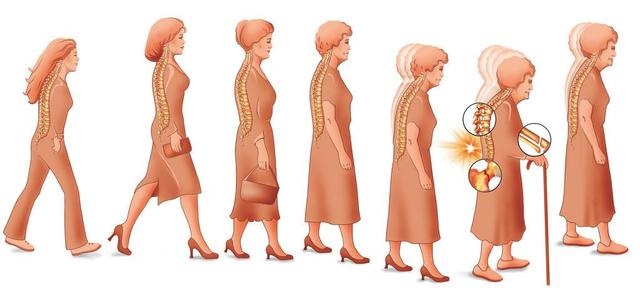 一分鐘測試題目評估你的骨質(zhì)疏松癥風(fēng)險